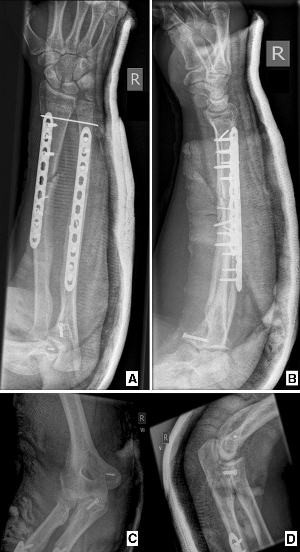 Fig. 3 Postoperative X-rays. a and b anterior posterior (AP) and lateral X-ray views of the forearm.