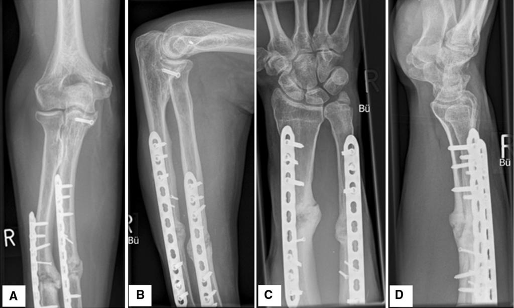Fig. 4 At 12-month postoperative follow-up. a, b anterior posterior (AP) and lateral X-ray views of the right elbow. c, d anterior posterior (AP) and lateral X-ray views of the right wrist.