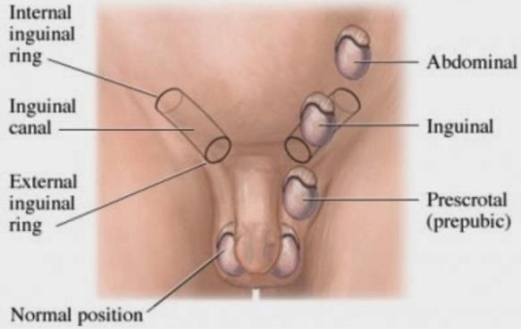 Congenital abnormalities of the testes: 1- Cryptorchidism Incomplete descent of the testis although traveling down the normal pathway, it may be found in the abdominal cavity, inguinal canal,