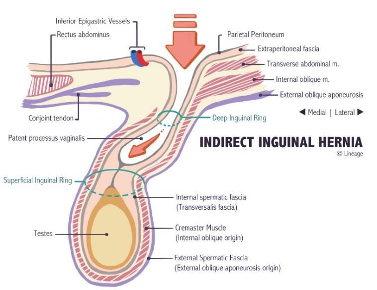 - There are many types of hernias, such as inguinal hernia, umbilical hernia, incisional hernia, etc. The inguinal hernia is the commonest and it can be either indirect or direct.