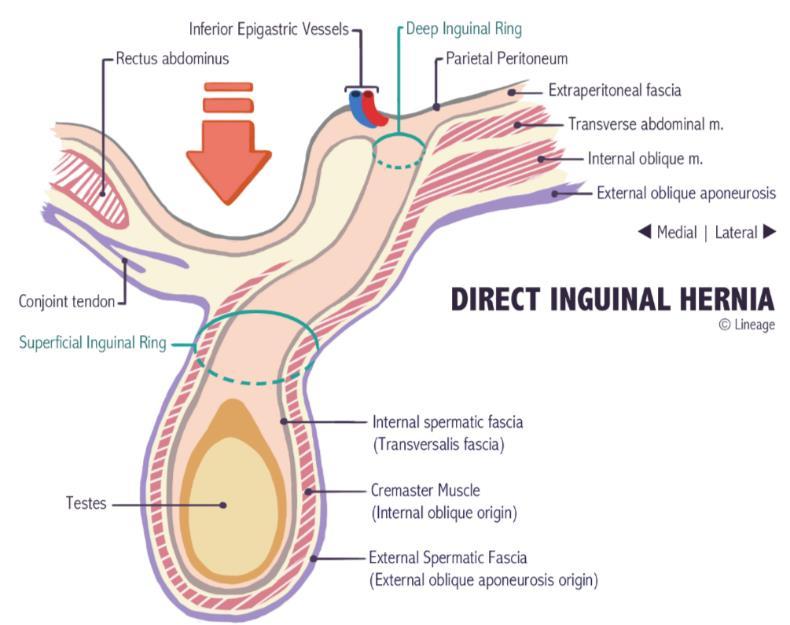 2- Direct - It composes about 15% of all inguinal hernias. - It is common in old men due to the weakness of the abdominal muscles and chronic constipation, rarely showing in females.