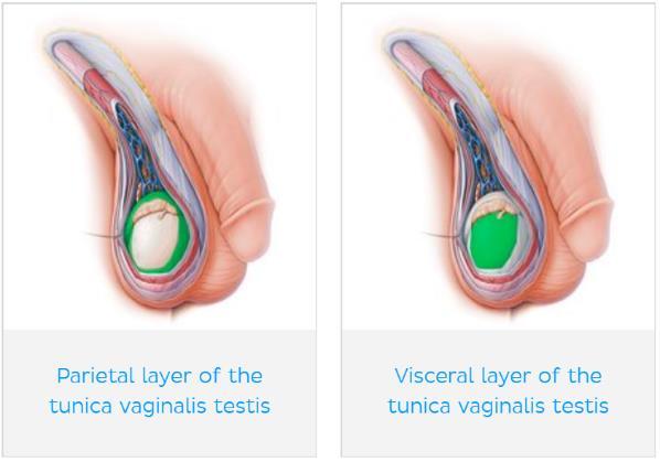 Hydrocele, the needle will pass through all layers of the scrotum except the visceral layer of the tunica vaginalis.
