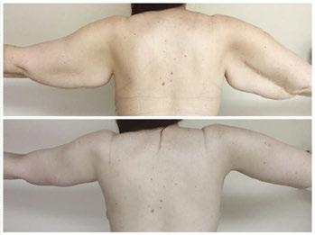 Aesthetic problem with adipose excess and scar due to trauma. Pre- and post-op.