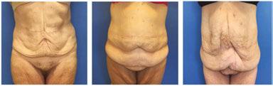 Body Contour Surgery in Massive Weight Loss Patients http://dx.doi.org/10.5772/64839 125 Upper section (arms, thorax, and upper back).