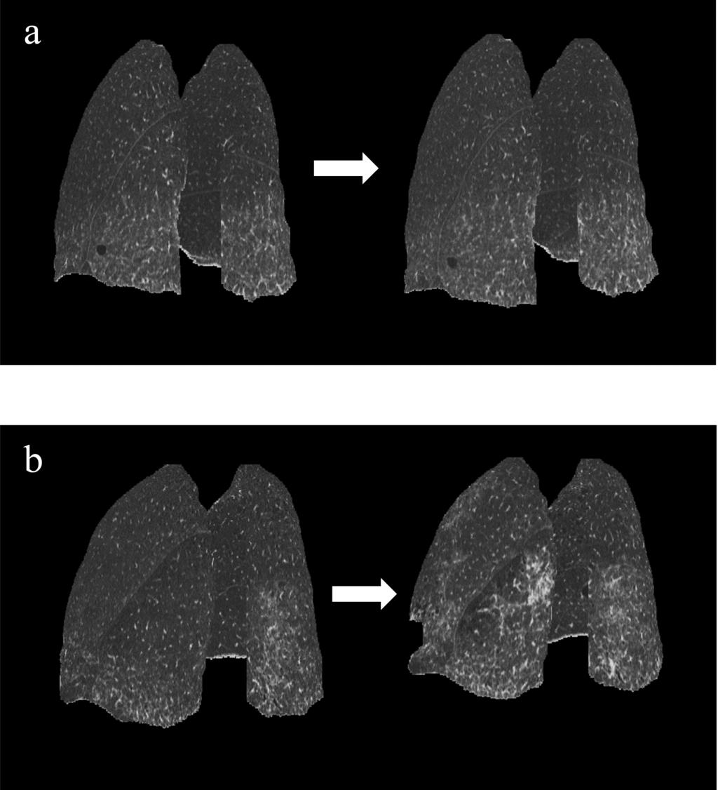3D-cHRCT images showing the 3D distribution of ILD infiltrates. 3D-cHRCT, three-dimensional curved high-resolution computed tomography; ILD interstitial lung disease Fig.
