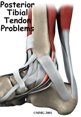 Introduction Because we use our feet continuously, tendonitis in the foot is a common problem. One of the most frequently affected tendons is the posterior tibial tendon.