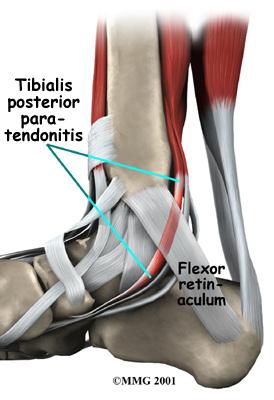 do? The posterior tibial tendon runs behind the inside bump on the ankle (the medial malleolus), across the instep, and into the bottom of the foot.
