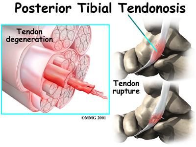 Treatment What can be done for the condition? Nonsurgical Treatment condition is called tendonosis. The area of tendonosis in the tendon is weaker than normal tendon.