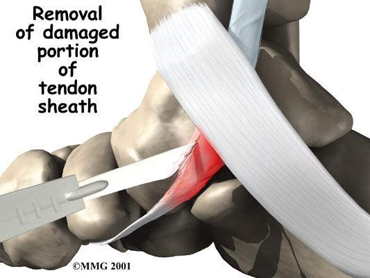 Symptoms What does tendonitis of the foot feel like? The symptoms of tendonitis of the posterior tibial tendon include pain in the instep area of the foot and swelling along the course of the tendon.
