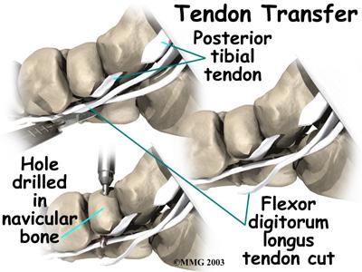 Tendon Repair A degenerated tendon that has not ruptured may only need to be repaired. The surgeon divides the sheath around the tendon. Areas where the tendon is degenerated are carefully removed.