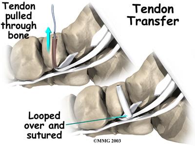 If the surgeon is concerned that the repaired tendon is at risk for rupturing, a graft procedure to add strength to the tendon may be needed (described below).