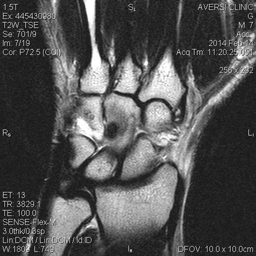 Osteoid Osteoma of wrist T1