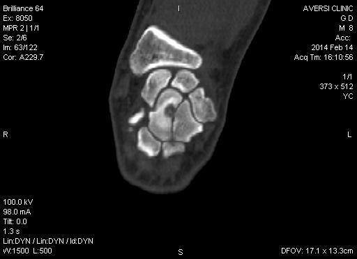 Osteoid Osteoma of wrist A coronal reformatted CT PDW-SPAIR
