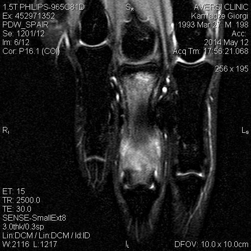 axial CT revealed nidus at the apex