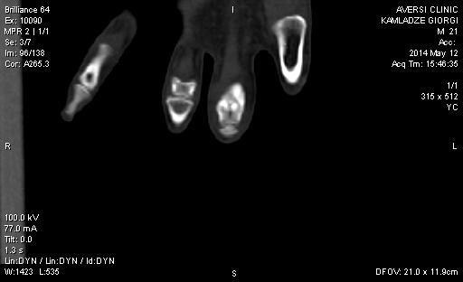 finger PDWSPAIR shows massive edema