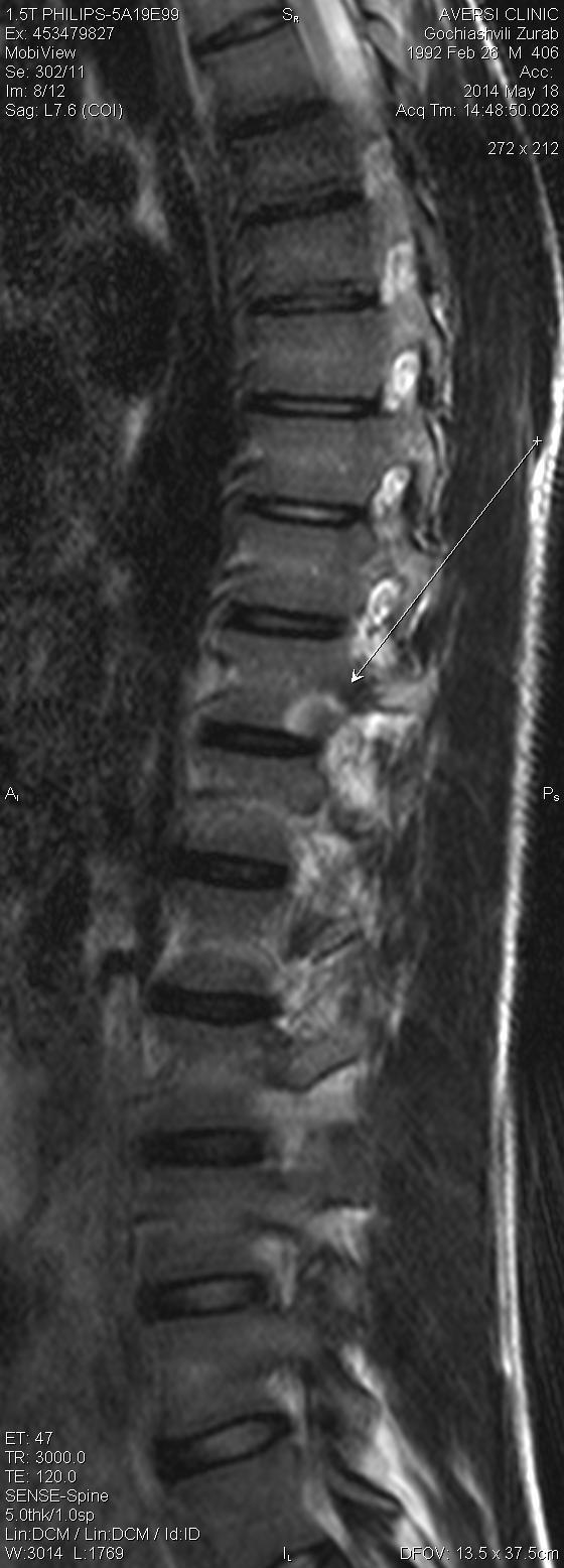 endplate of Th11 vertebral body with central hypointenssive focus