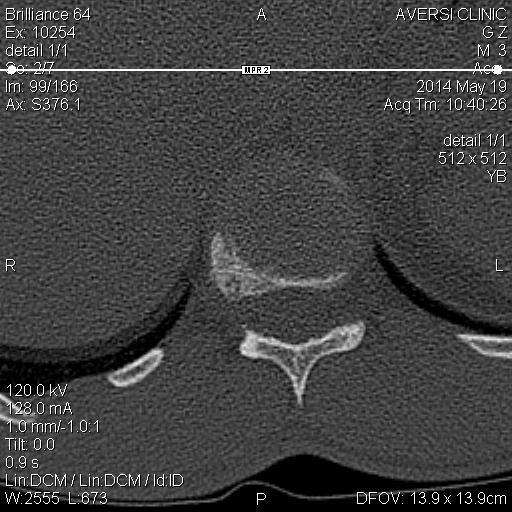 Osteoid Osteoma of Thoracic vertebra T2