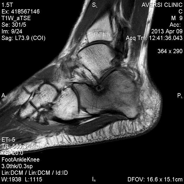 Osteoid Osteoma of calcaneus T1 weighted