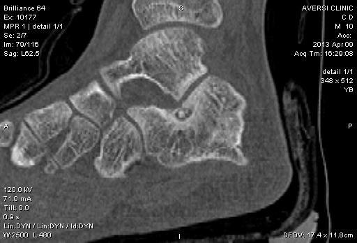 Osteoid Osteoma of calcaneus CT