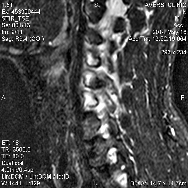 vertebrae T2-weighted coronal image demonstrates a well circumscribed