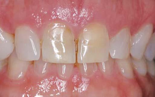 Diagnostic waxup depicting the new incisal edge and gingival margin position.