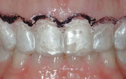 CASE PRESENTATION A healthy 43-year-old female patient was referred for a consultation regarding improving the appearance of her teeth and smile.