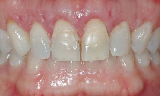 Options for correction of excess gingival display include orthodontics, periodontal crown lengthening, and orthognathic surgery.