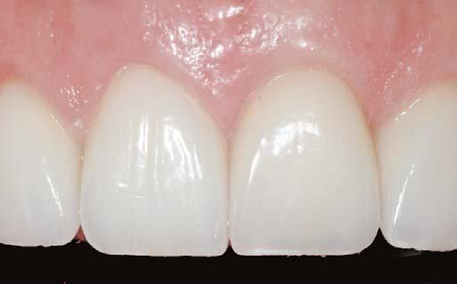SURGICAL CROWN LENGTHENING On her first periodontal appointment, a comprehensive periodontal examination was performed.