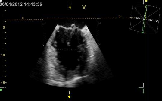 Part II: Fundamentals of 3D Echocardiography: Acquisition and Application Dr.
