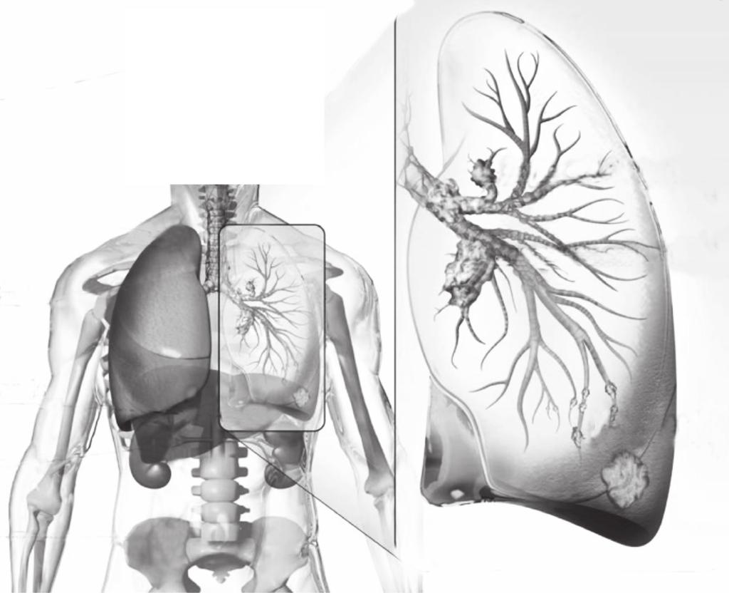 4 30 35 40 1. Introduction Lung cancer is one of the most common and serious types of cancer. Over 41 000 people are diagnosed with the condition every year in the UK.