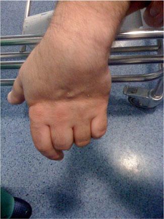 swelling, and dysfunction of his left hand, without any complaints of neurovascular deficits (Fig. 1).