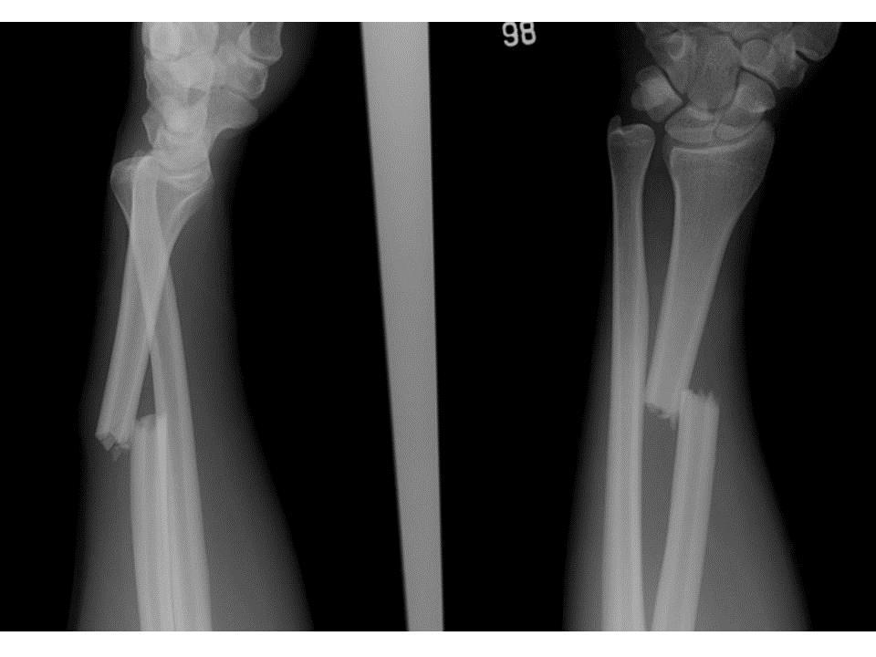 Forearm Galeazzi fracture