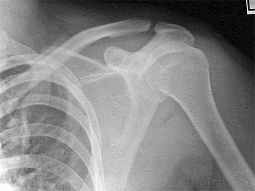 Quiz 1 A 32 year-old gardener fall on left shoulder 2 hour before visiting doctor.