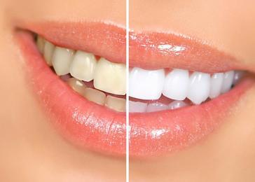 Almost all whitening methods are similar in concept, but some are much more effective because of the way the whitening material is delivered to the teeth.