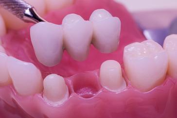 Dental Crowns And Bridges A crown (cap) is a restoration that is placed on teeth that have lost a lot of their structure.