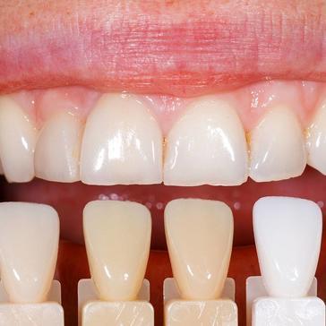 Although not as permanent as a cap, bridges are bonded to the surrounding teeth and only removable by your dentist.