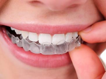 When more than half of the tooth s biting surface is damaged, a dentist will often use an inlay or onlay.