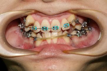 Different Types of Braces Metal braces are the most popular with kids and teenagers. They love using different colors of ligature ties.