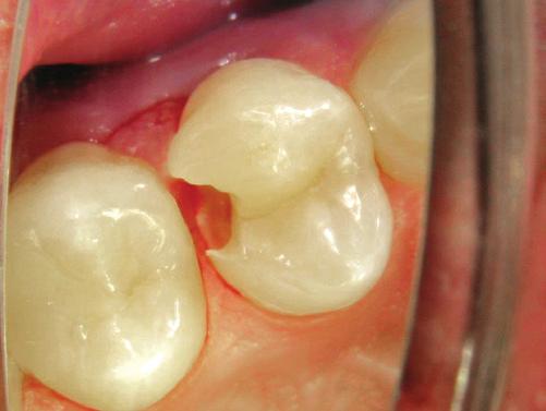 cavity prep on first molar Photos  Leon