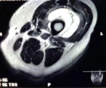 Figure 1 MRI image Figure 2 Axial section T2W image Based on these findings the
