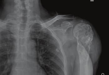 The nodular opacity in left mid zone that was seen on the X-ray was presumed to be a calcified granuloma as it showed no activity on bone scan.