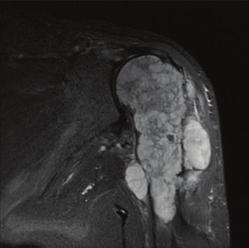 Coronal T2WI showing hyperintense lobulated mass with fibrous septae (arrow). 2.1. Skeletal Distribution.