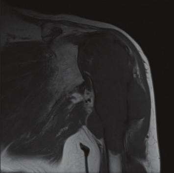 Plain films allow depicting the location of the lesion to identify the cartilaginous nature as well as its aggressiveness.