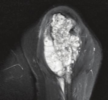 In typical forms, MRI shows a lobulated lesion with a low or intermediate signal on T1-weighted images and a high-signal intensity on T2 [4].