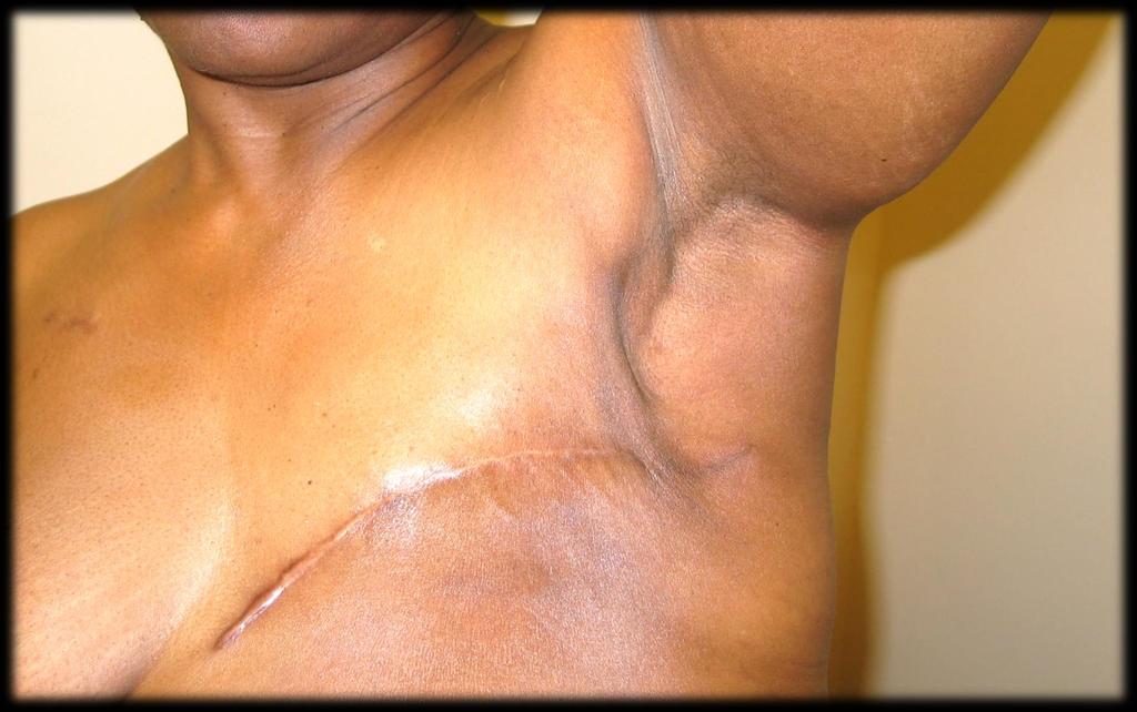 Decreased extensibility of Pectoral muscle Axillary cording Decreased