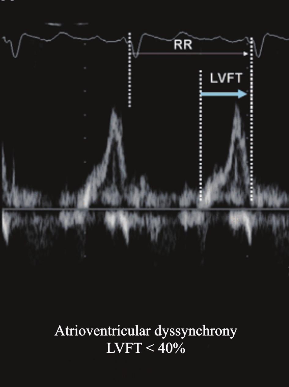 Efthimios Livanis a, Vassilis Voudris a Cardiac dyssynchrony is divided into electrical dyssynchrony and mechanical dyssynchrony.