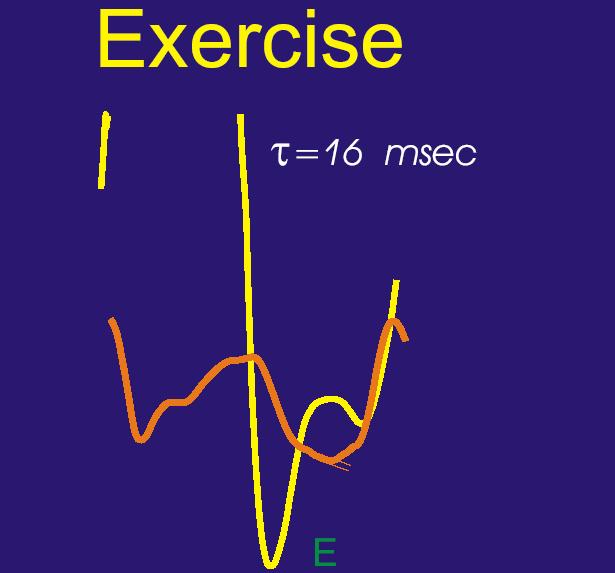 IVPG are Critical During Exercise Diastole Disproportionately Shortened IVPG IVPG