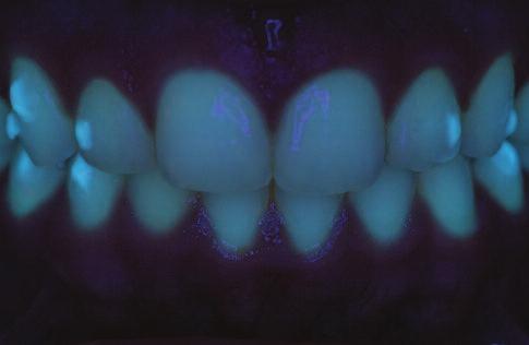 C L I N I C A L 2 3 Figure 2: UV-induced fluorescence of natural teeth (fluor_eyes by emulation) Figure 3: Near-UV induced fluorescence of natural teeth (Digi- Slave L-Ring 3200UV by SR Inc.