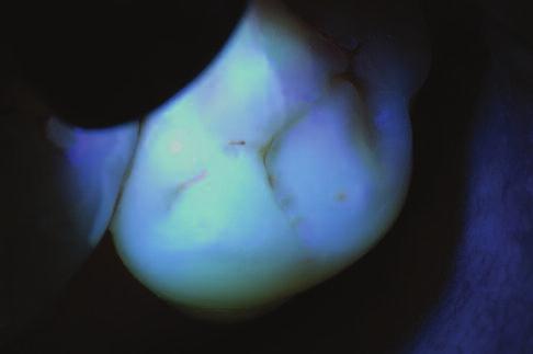 While a natural fissure staining will remain dark under near-uv light, the fissures with plaque and bacterial activity will show a strong red fluorescence (Figure 8b).