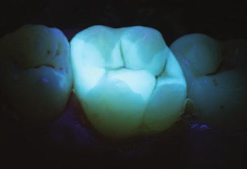 Detection of fluorescent composite restorations or resin cements Most modern restorative composites and resin cements contain fluorophores in order to display a natural-looking fluorescence under UV